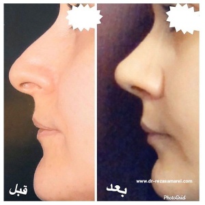 جراحی-بینی-1