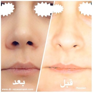 جراحی-بینی-2