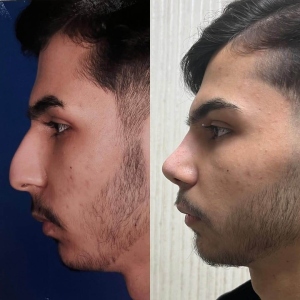 دوماه-بعد-از-جراحي-بيني