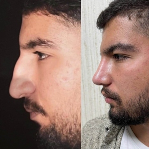سه-ماه-بعد-از-جراحي-بيني