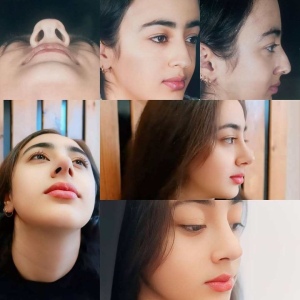 سه-ماه-بعد-از-جراحی-بینی