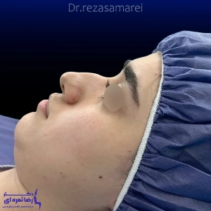 1_rhinoplasty-60