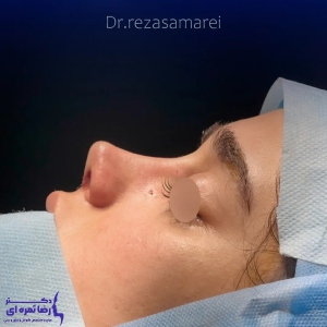 1_rhinoplasty-61
