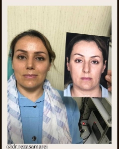 One-month-after-nose-surgery