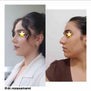 Semi-fancy-rhinoplasty
