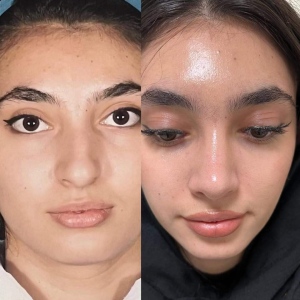 Three-months-after-nose-surgery
