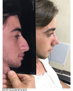 Three-weeks-after-rhinoplasty