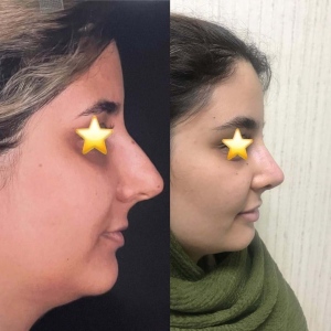Two-months-after-bone-nose-surgery-2