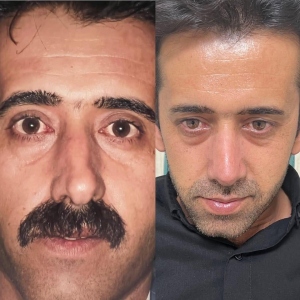 Two-months-after-crooked-nose-surgery