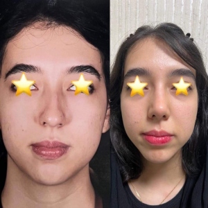 Two-months-after-fleshy-nose-surgery