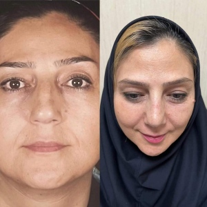 Two-months-after-nose-surgery-with-thin-skin