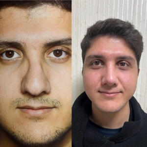 Two-months-after-nose-surgery