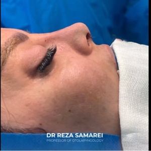 rhinoplasty-22