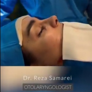 rhinoplasty-23