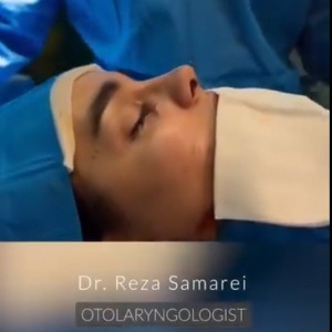 rhinoplasty-25
