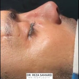 rhinoplasty-26