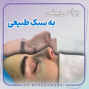 rhinoplasty-28