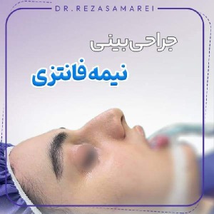 rhinoplasty-29