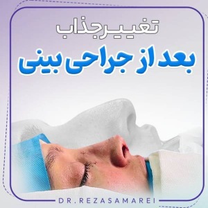 rhinoplasty-30