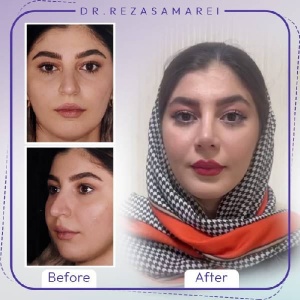 rhinoplasty-31
