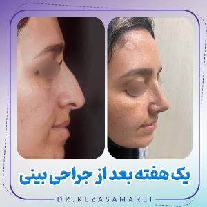 rhinoplasty-32