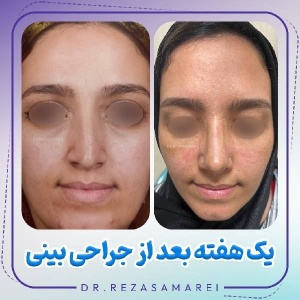 rhinoplasty-33