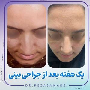 rhinoplasty-34