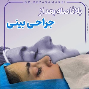 rhinoplasty-36