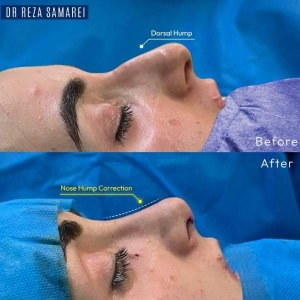 rhinoplasty-37