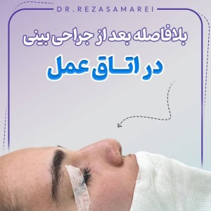 rhinoplasty-38