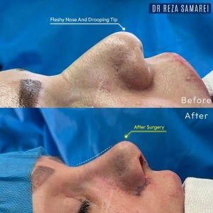 rhinoplasty-39