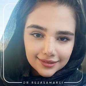rhinoplasty-40