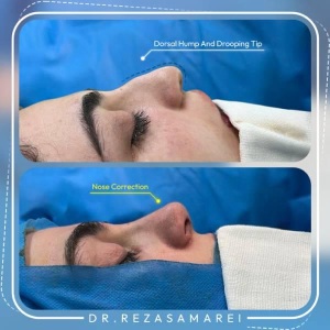 rhinoplasty-41