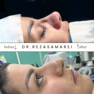 rhinoplasty-42