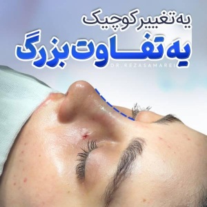 rhinoplasty-43