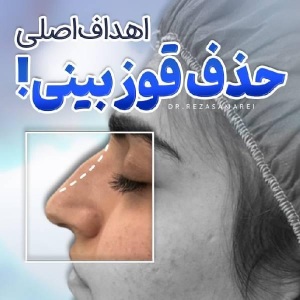rhinoplasty-44