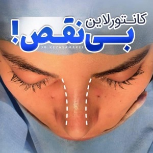 rhinoplasty-45