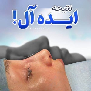 rhinoplasty-46