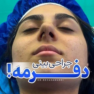 rhinoplasty-47