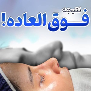rhinoplasty-48