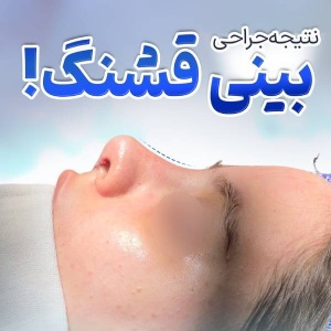 rhinoplasty-49