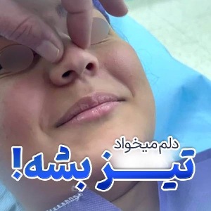 rhinoplasty-50