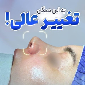 rhinoplasty-51