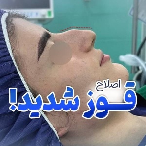 rhinoplasty-52
