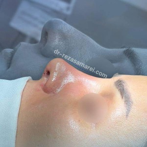 rhinoplasty-53