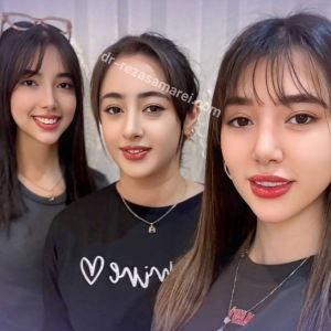 rhinoplasty-54