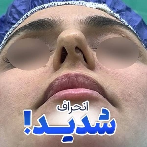 rhinoplasty-55