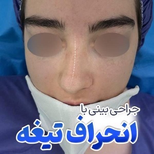 rhinoplasty-56
