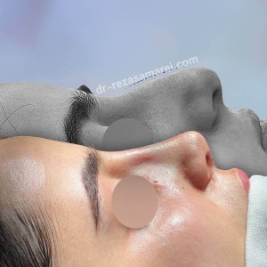 rhinoplasty-57