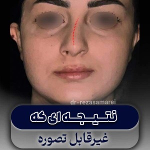 rhinoplasty-58